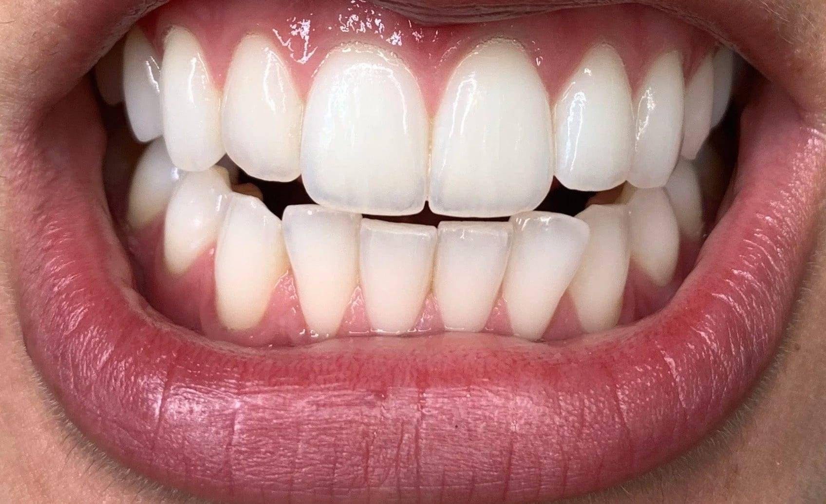 Close-up of a bright, even smile after a teeth whitening session