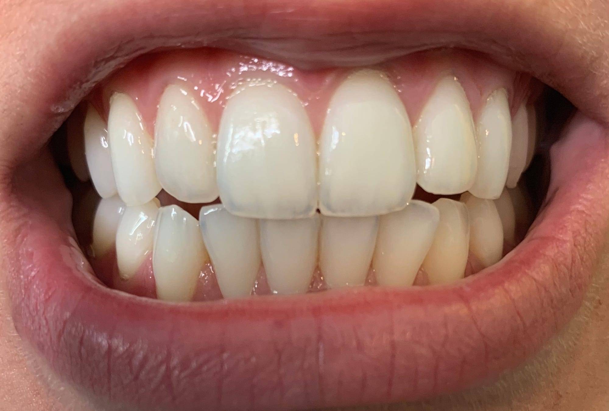Close-up of whitened teeth after a whitening session